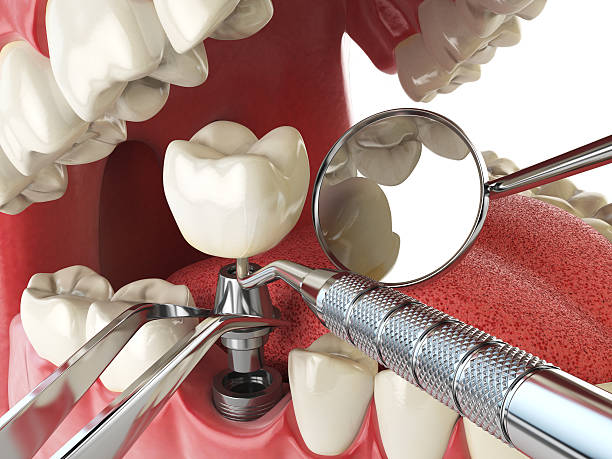 Best Emergency Tooth Extraction in Pflugerville, TX